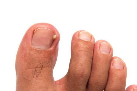 Cure Pain From Toenail Fungus Infection