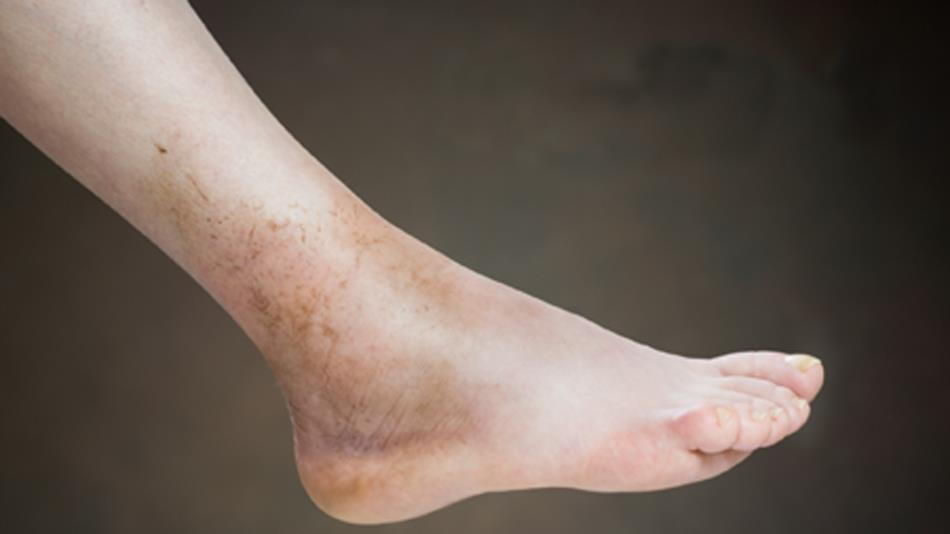 foot-swelling.jpg