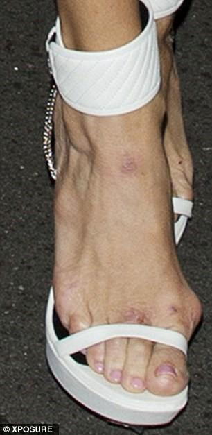 Taking a toll: On closer inspection, large blisters were also seen on Brandi's feet