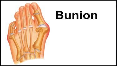 bunions.png