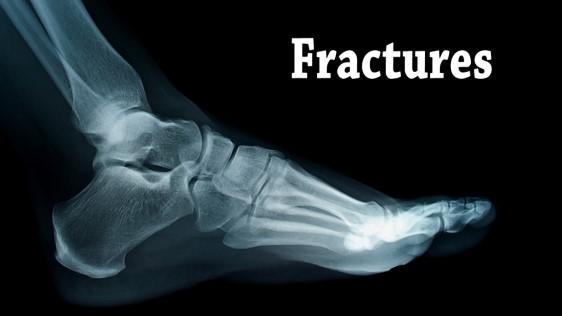 fracture.jpg