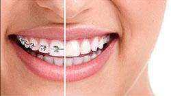 Interceptive Orthodontics