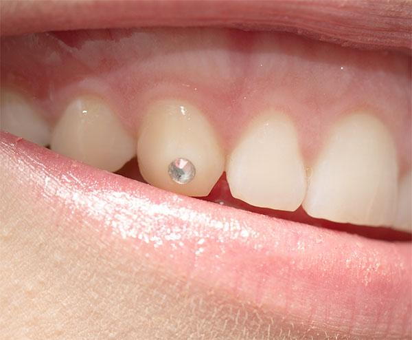 tooth gems tooth jewel mississauga dentist
