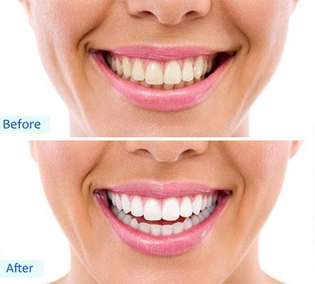 teeth whitening results mississauga dentist