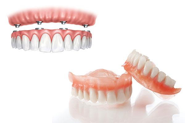 implant denture mississauga dentist dental