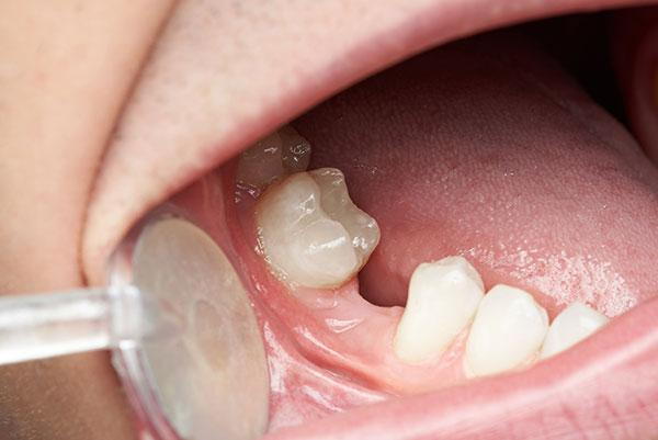 congenitally missing teeth treatment mississauga