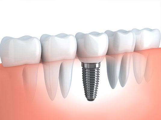 dental implant missing teeth mississauga