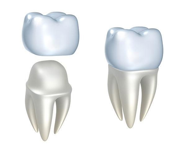 when is a dental crown needed mississauga dentist