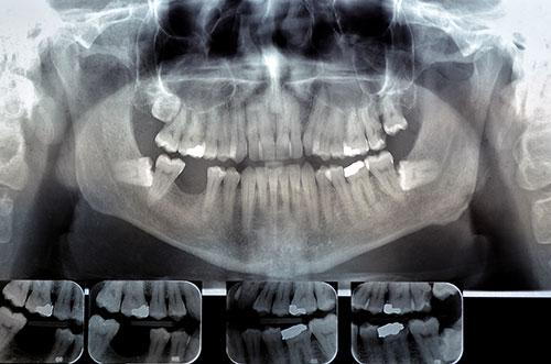what do dental xrays look like mississauga dentist