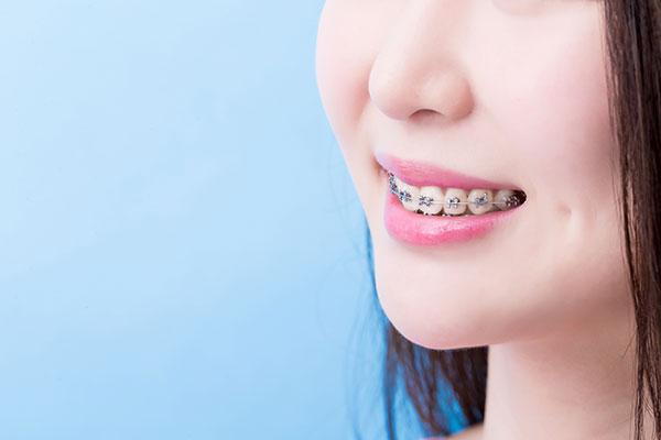 braces retainer mississauga dentist bonded dental arts