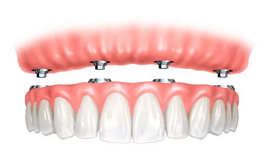 implant supported denture in mississauga, on