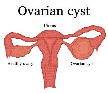 Ruptured Ovarian Cysts: Symptoms, Causes, Treatment