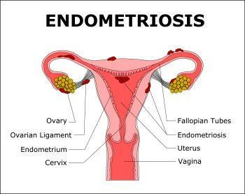 Endometriosis