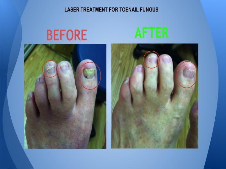 Fungal Nail Infections: Best Fungal Nail Treatments | Simply Feet