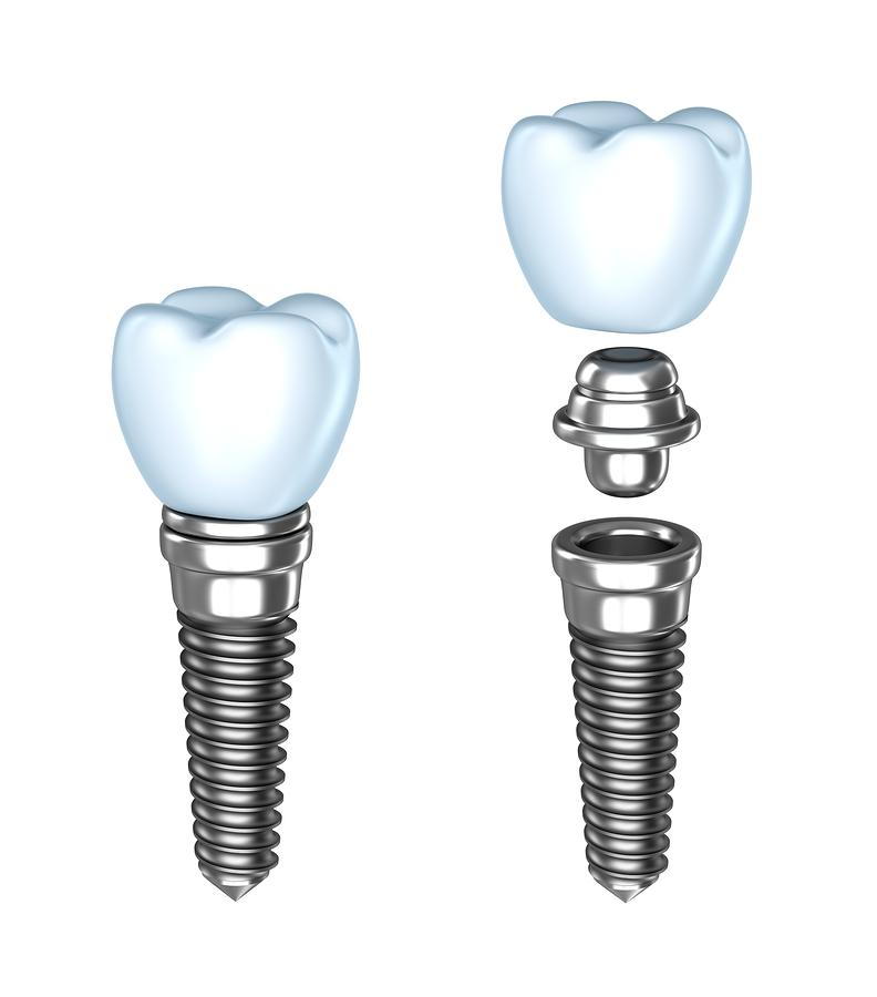 dental implants, dental crowns