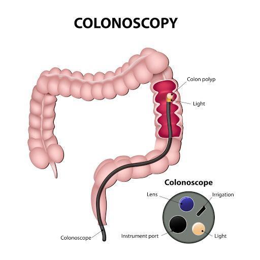 side effects from colonoscopy