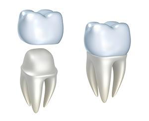 dental crowns, dental bridges