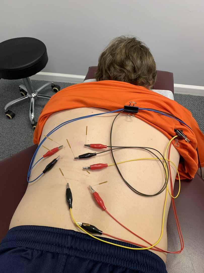 A man having some dry needling session