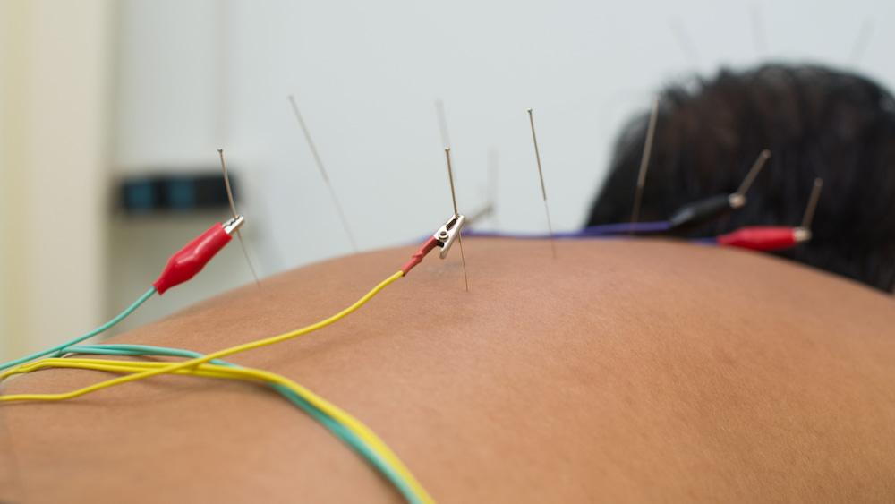 Dry needling session