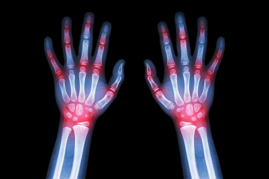 arthritis pain