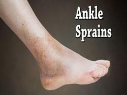 Ankle Sprain