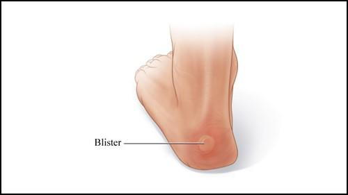 blisters.jpg