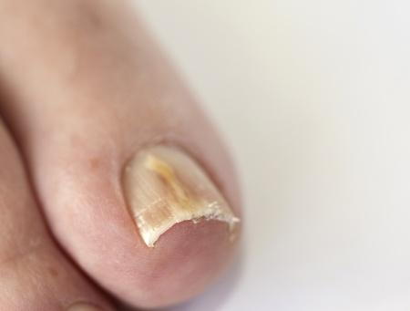 The White Patches on Your Toenails, Explained | Triad Foot & Ankle Center