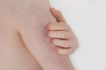 Keratosis Pilaris can cause bumps on your arms