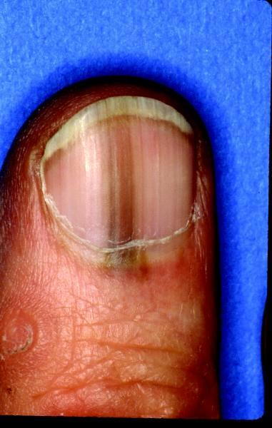 Routine nail clipping leads to the diagnosis of amelanotic nail unit  melanoma in a young construction worker - Boni - 2015 - Journal of  Cutaneous Pathology - Wiley Online Library