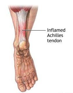 Stiff achilles sale tendon after sitting