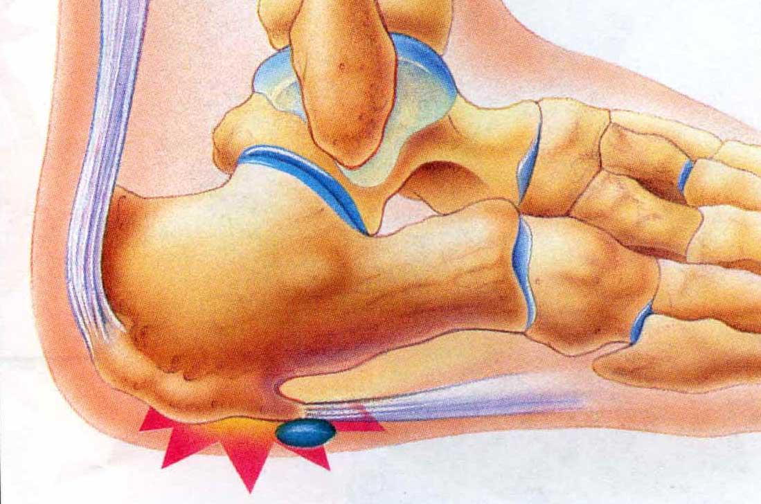 sudden-stabbing-pain-in-back-of-heel-what-causes-it-the-medic-tips