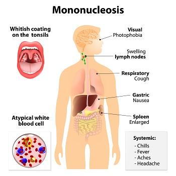 The Kissing Disease - Infectious Mononucleosis 