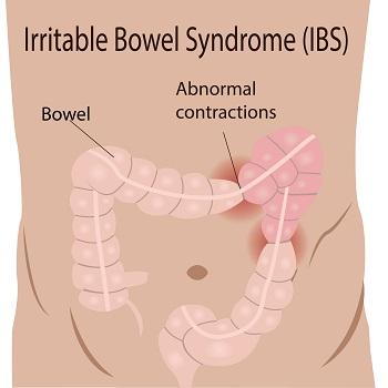 Bloating - Do You Suffer with this Common Symptom? - About IBS