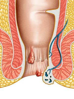 internal hemorrhoid bleeding