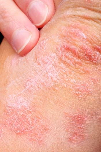 Eczema is made up of itchy patches of dry skin