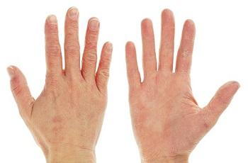 Dermatitis on back and front of hands