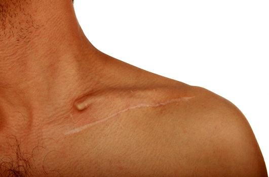 What You Need to Know About Scars Tissue After an Accident