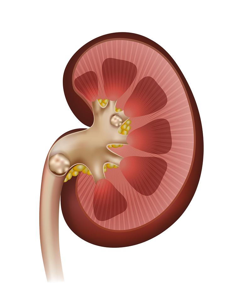 Kidney Stones, Kidney Stone Symptoms, Nephrolithiasis