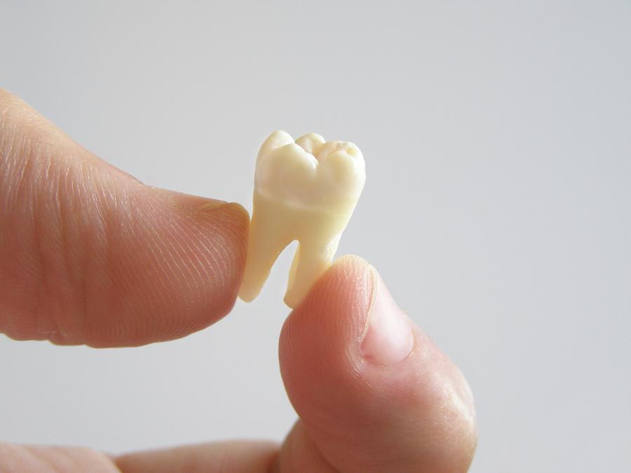 Molar Tooth Extraction