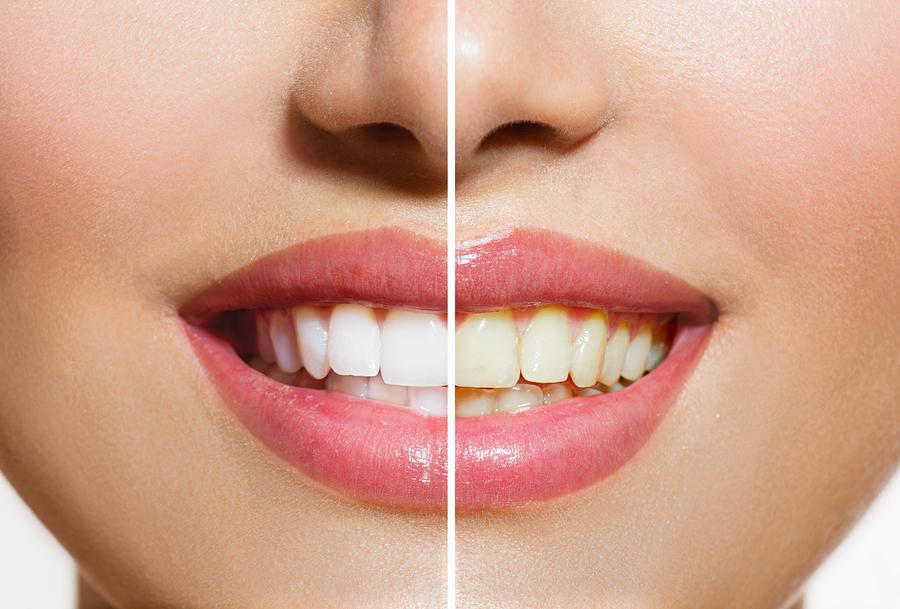 Professional Teeth Whitening