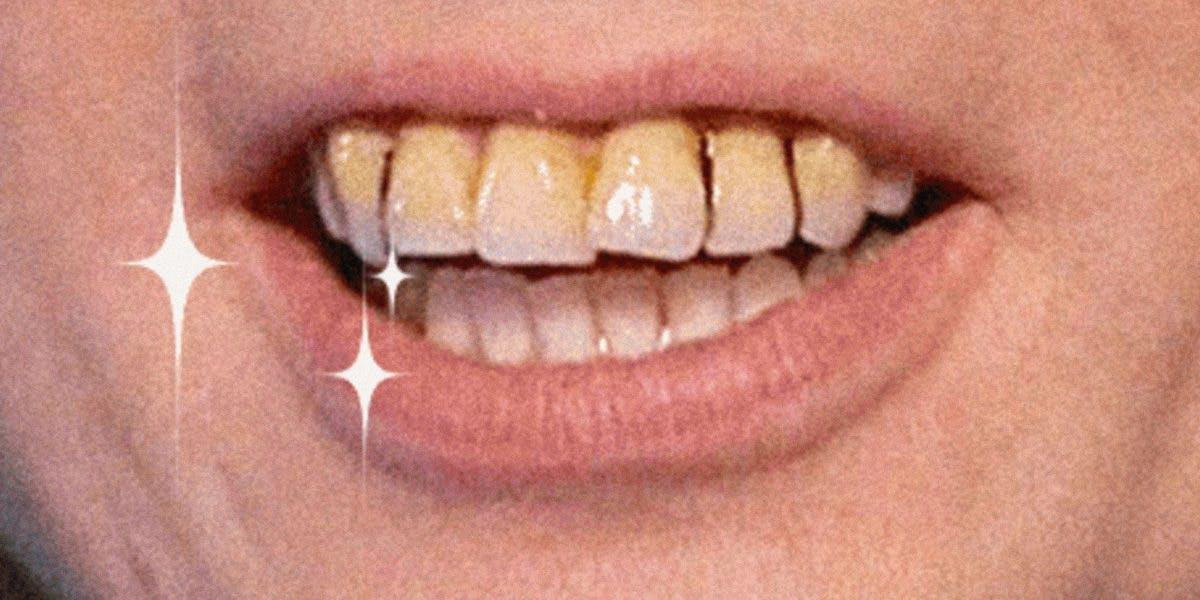 Can You Be Born With Bad Teeth?