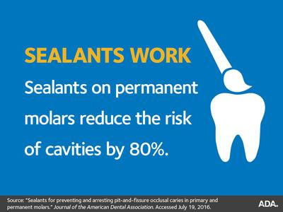 sealants on permanent molars reduce risk of cavities by 80%