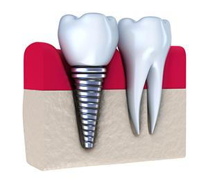 sideview of a dental implant