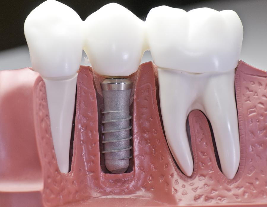 Dental Gaps, Dental Implants, Dental Replacements