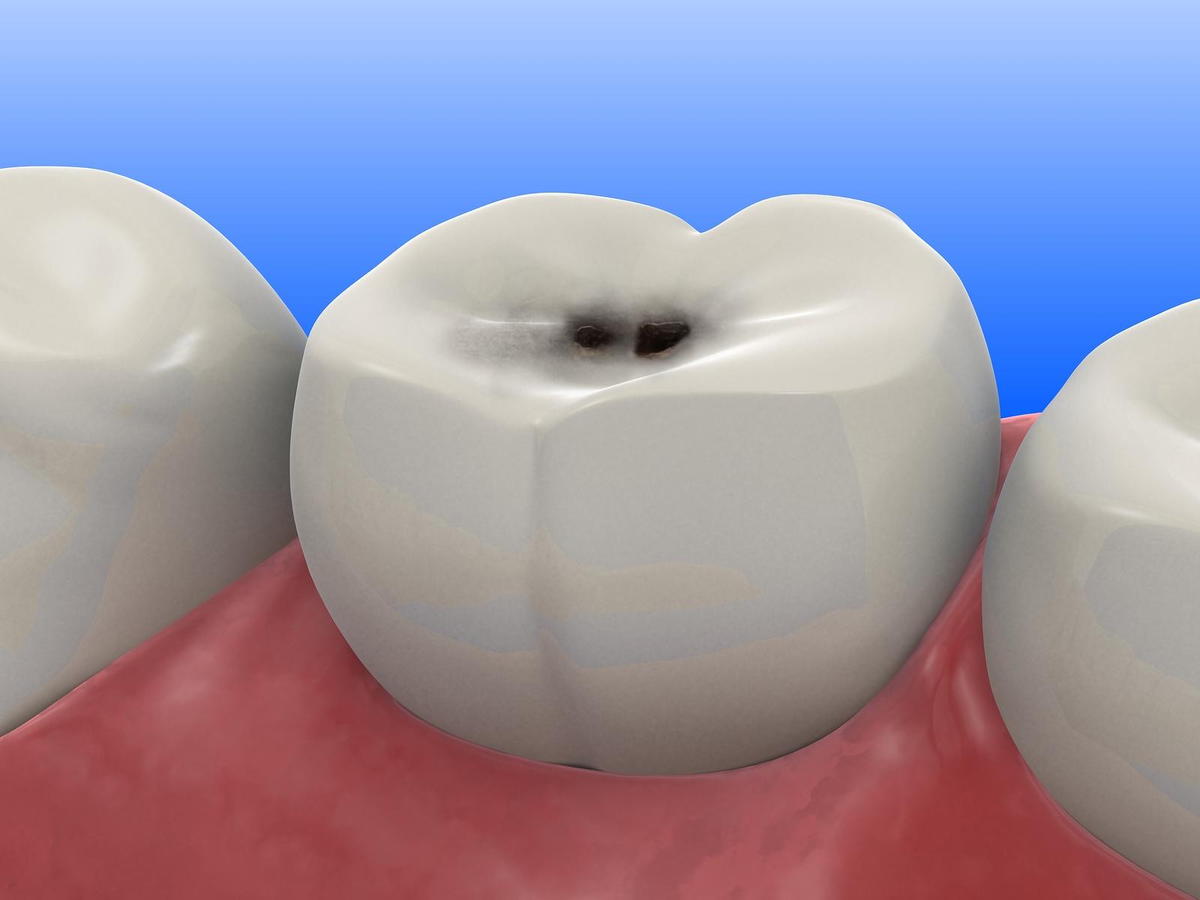 Tooth Colored Fillings in Kenosha, WI