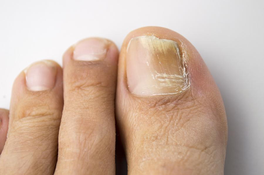 Ingrown Toenail Treatment: The Sunset Foot Clinic: Podiatry