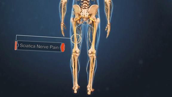 Animated gif showing pain radiating on the path of the sciatic nerve