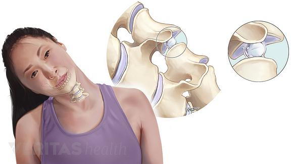 Medical illustration of the gas bubbles within the cervical facet joints that lead to crepitus