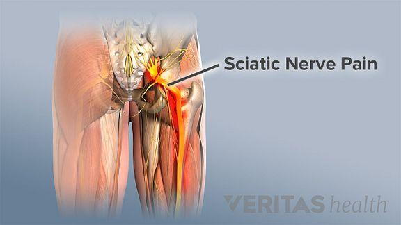 Massage therapy is a commonly overlooked treatment for sciatic pain