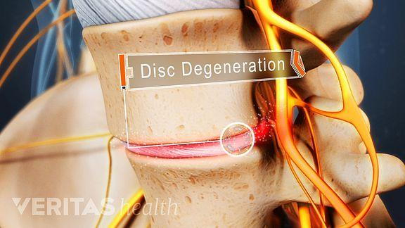 disc-degeneration-caused-sciatica.jpeg?u=at8tiu&use=idsla&k=c
